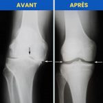 Attelle de genou orthopédique ajustable et respirante | OrthoKnee™ - Occamarket
