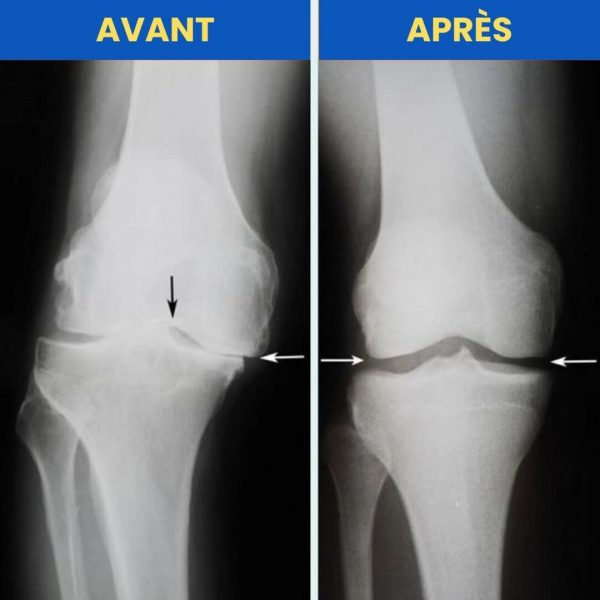 Attelle de genou orthopédique ajustable et respirante | OrthoKnee™ - Occamarket