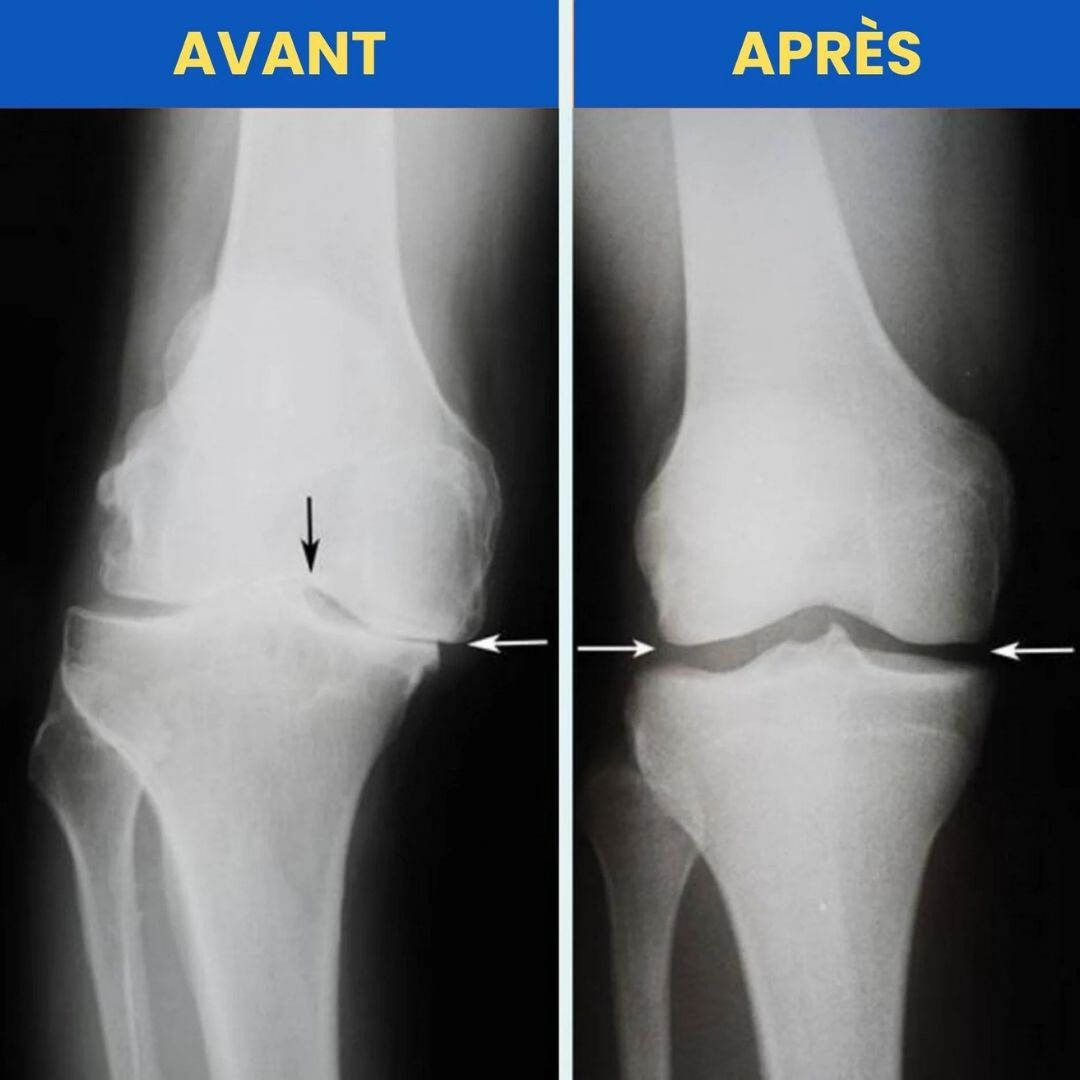 luxo7-24141-1 Attelle de genou orthopédique ajustable et respirante | OrthoKnee™ - Occamarket