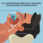 Gouttières Anti Ronflement et Anti Bruxisme - Occamarket