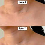 Epidelya – Kit traitement des acrochordons - Occamarket